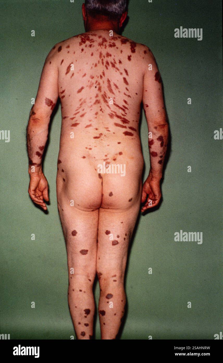 secondary melanotic sarcoma Soft-Tissue Clear cell sarcoma of tendons