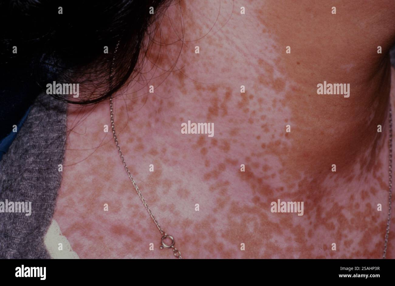 Vitiligo or achromia is an autoimmune disease, linked to a dysfunction ...