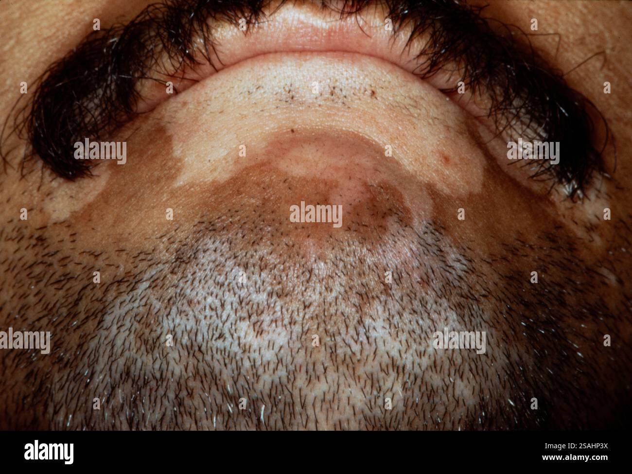 Vitiligo or achromia is an autoimmune disease, linked to a dysfunction ...