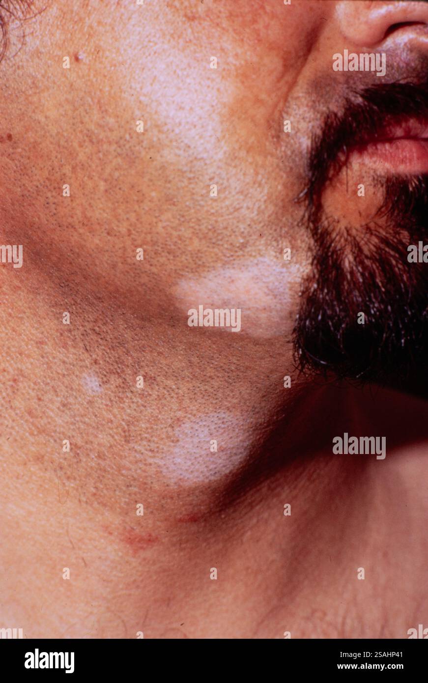 Vitiligo or achromia is an autoimmune disease, linked to a dysfunction ...