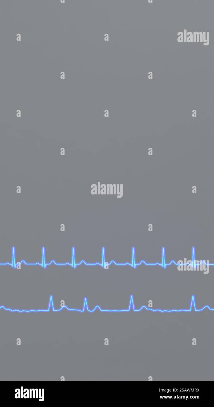 Normal Heart Rhythm ECG and Atrial Fibrillation. Stock Photo