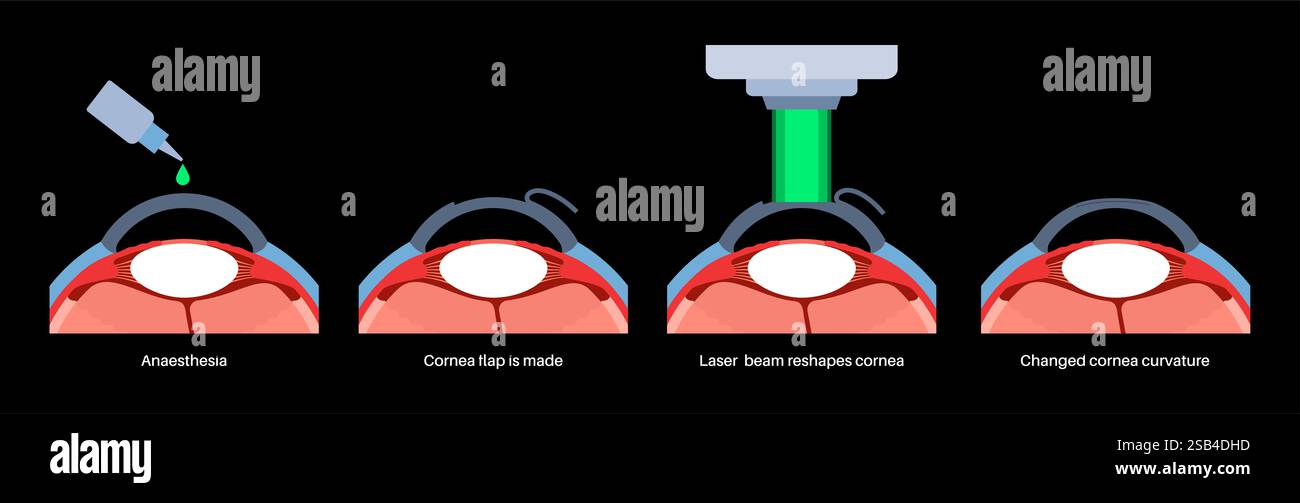 illustration-of-lasik-laser-assisted-in-situ-keratomileusis-also