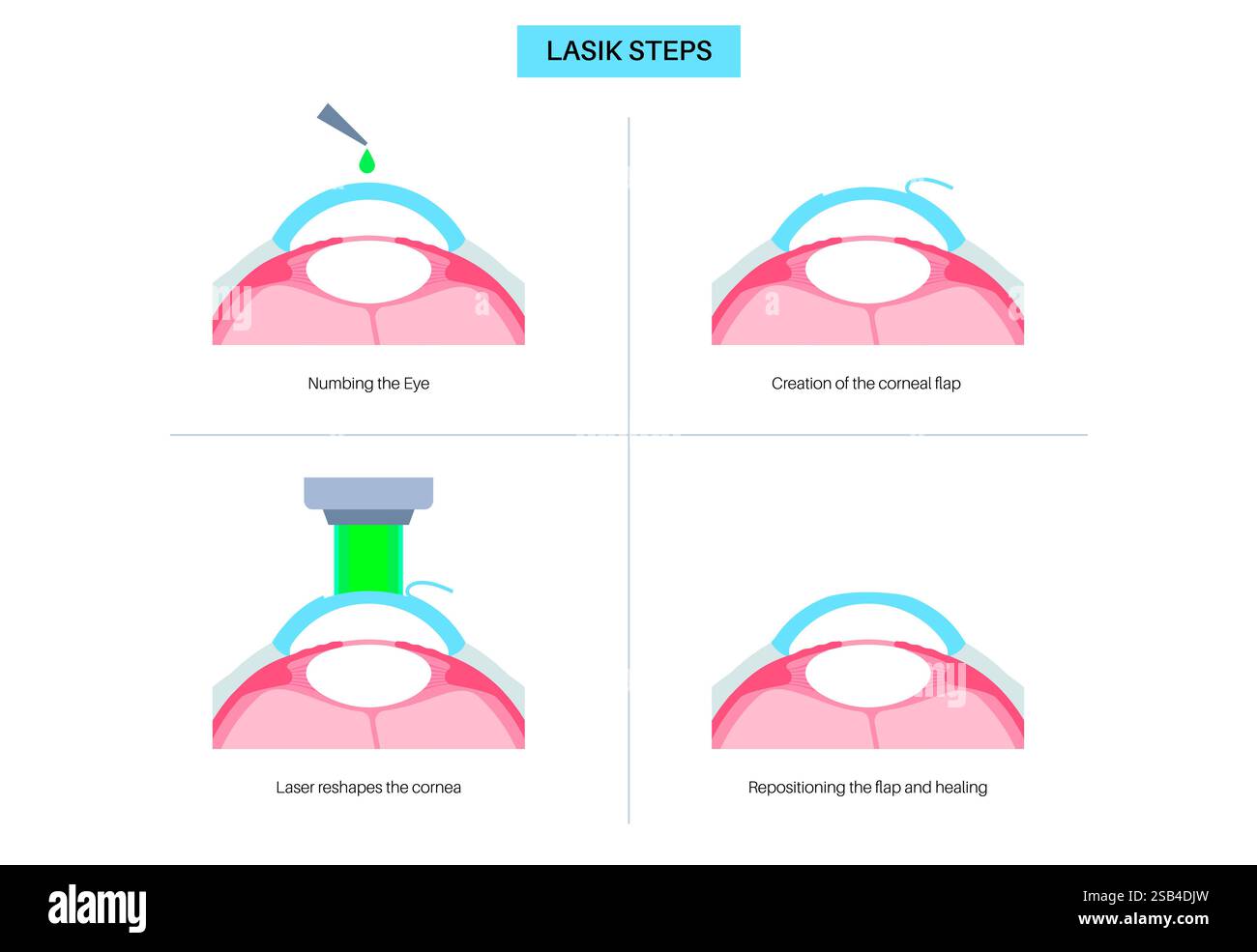 Laser assisted in situ keratomileusis Cut Out Stock Images