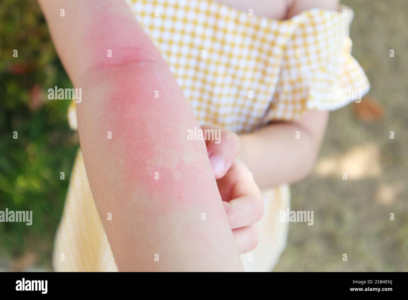 Little girl has skin rash allergy and itchy on her arm Stock Photo - Alamy