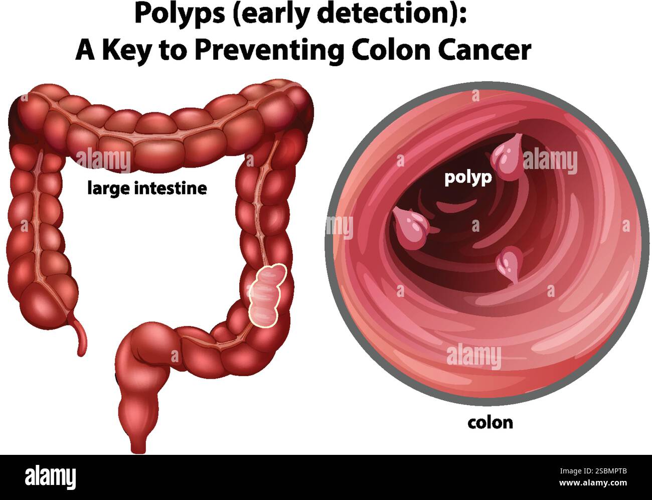 Illustration Of Colon Polyps And Large Intestine Stock Vector Image 