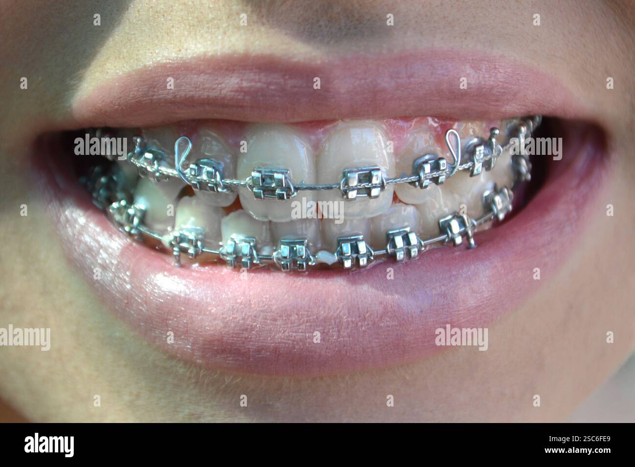 Teeth with dental braces Stock Photo - Alamy
