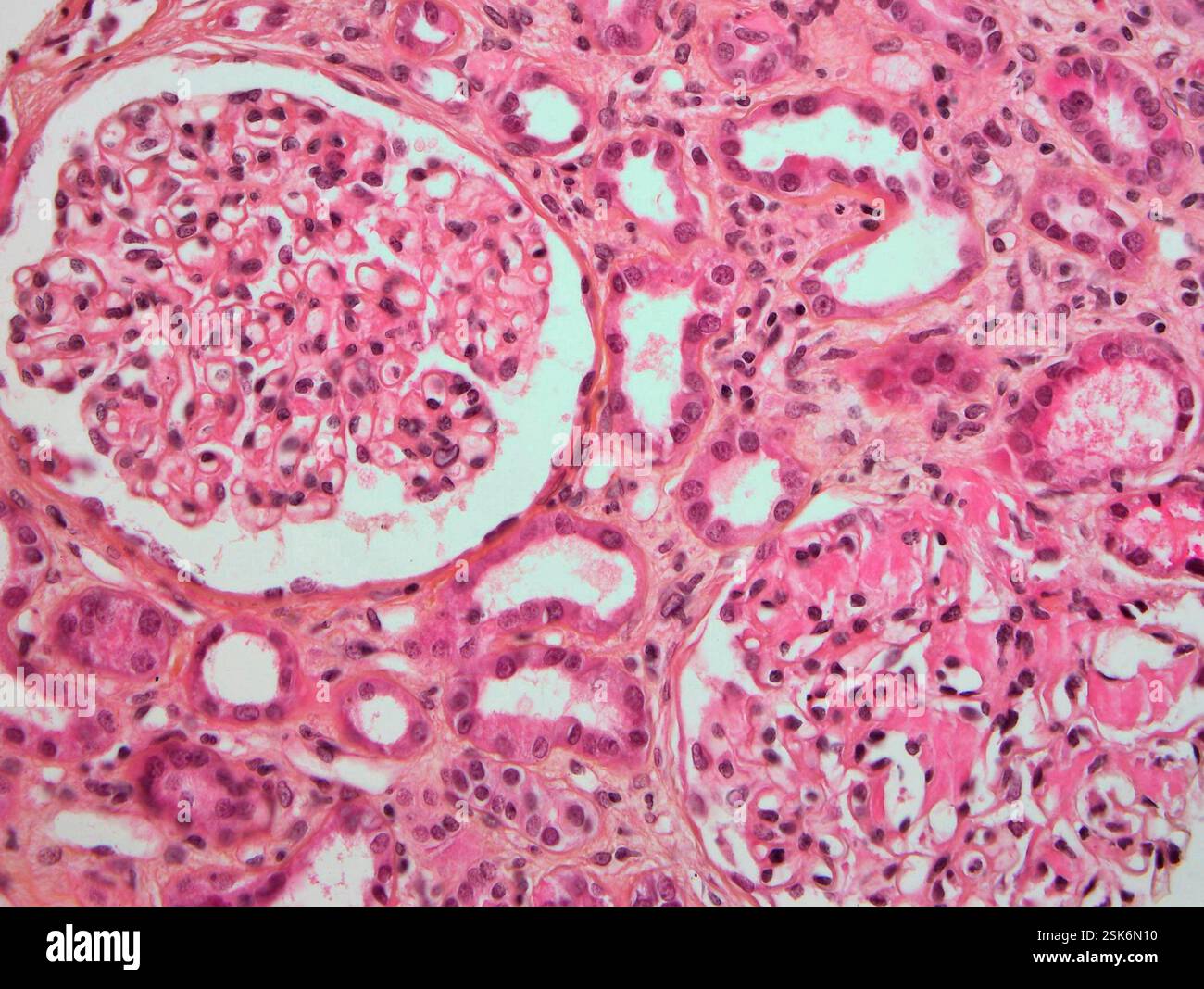 Renal amyloidosis. Light micrograph of a section through a kidney ...