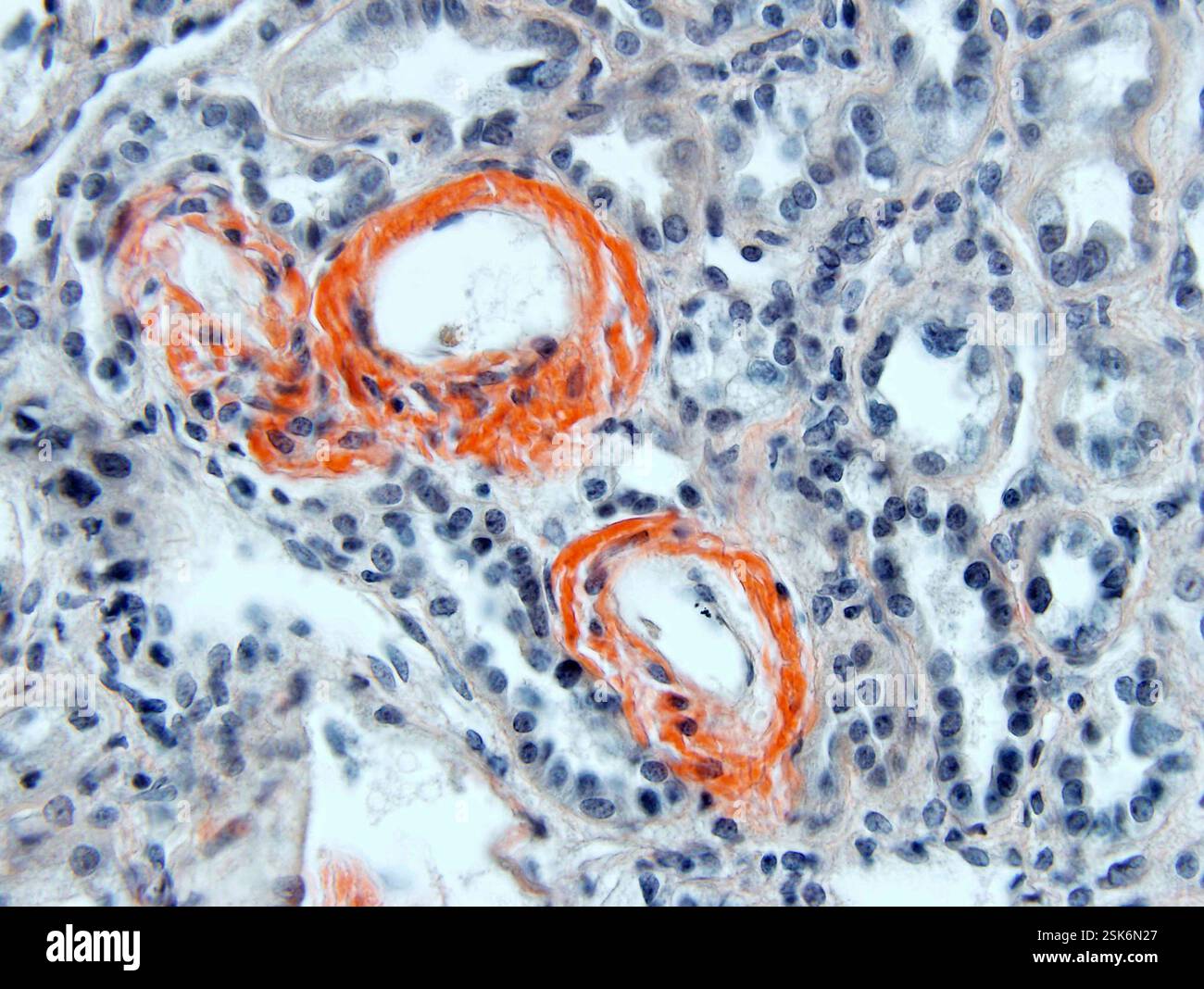 Renal amyloidosis. Light micrograph of a section through a kidney ...