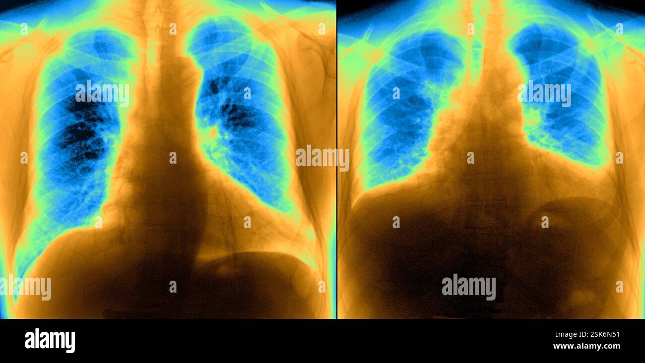 Healthy lungs. Coloured frontal chest X-ray showing a young man's lungs ...