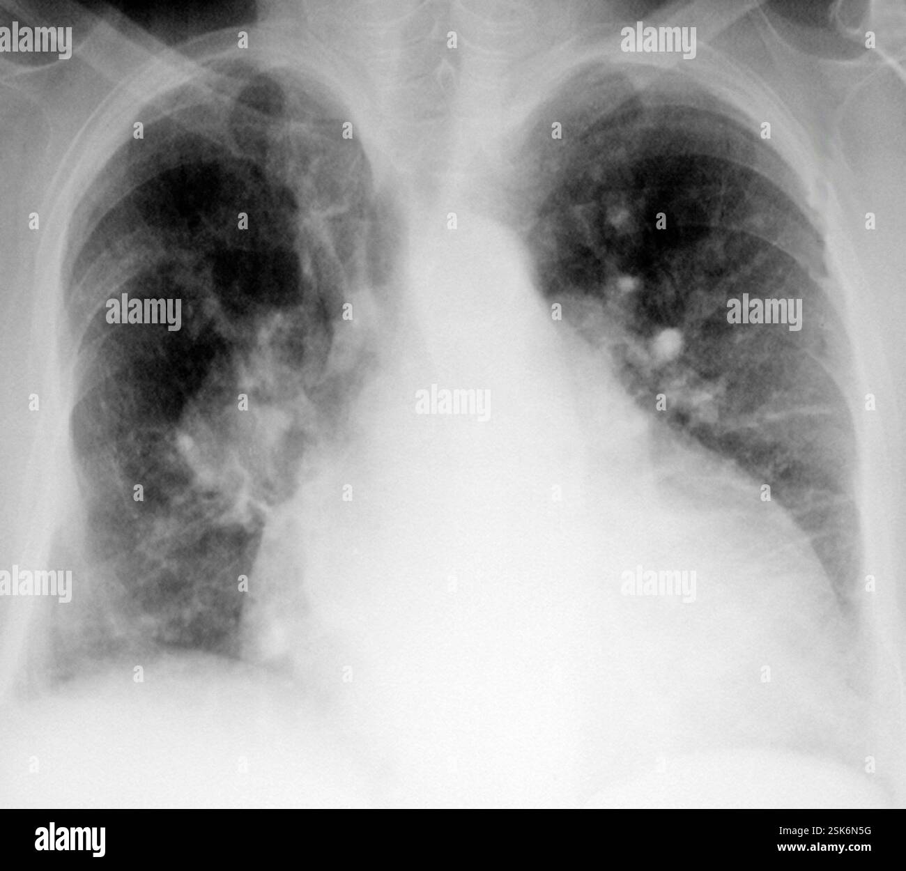 Cardiomegaly. Frontal X-ray of the chest of a patient with cardiomegaly ...