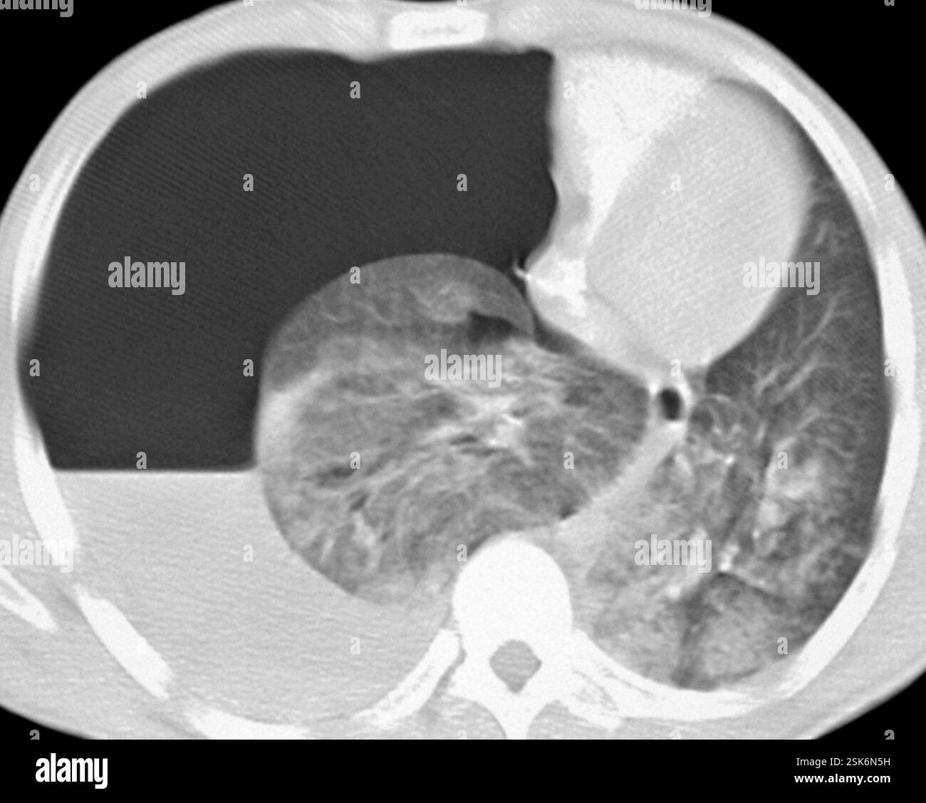 Haemopneumothorax. Computed tomography (CT) scan of the chest of a ...