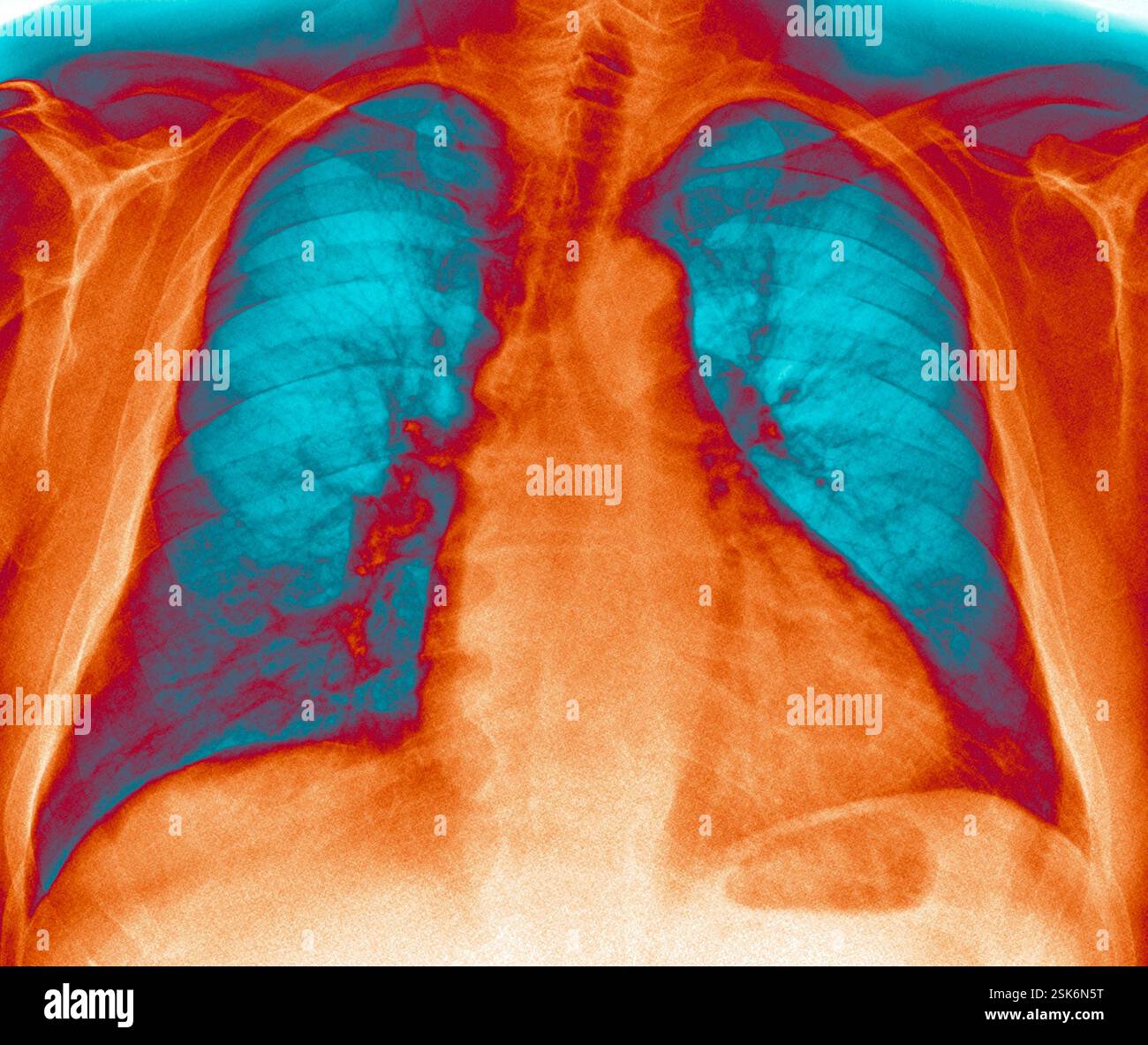 Cardiomegaly. Coloured frontal X-ray of the chest of a patient with ...