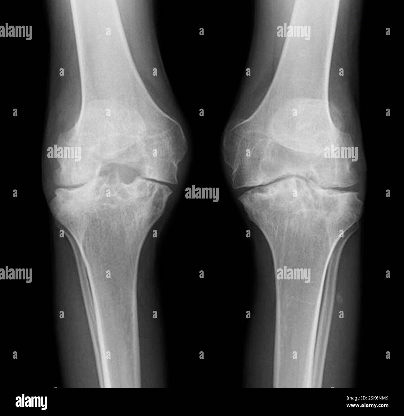 Infected knee joint. Frontal X-ray of the knees of a patient with ...