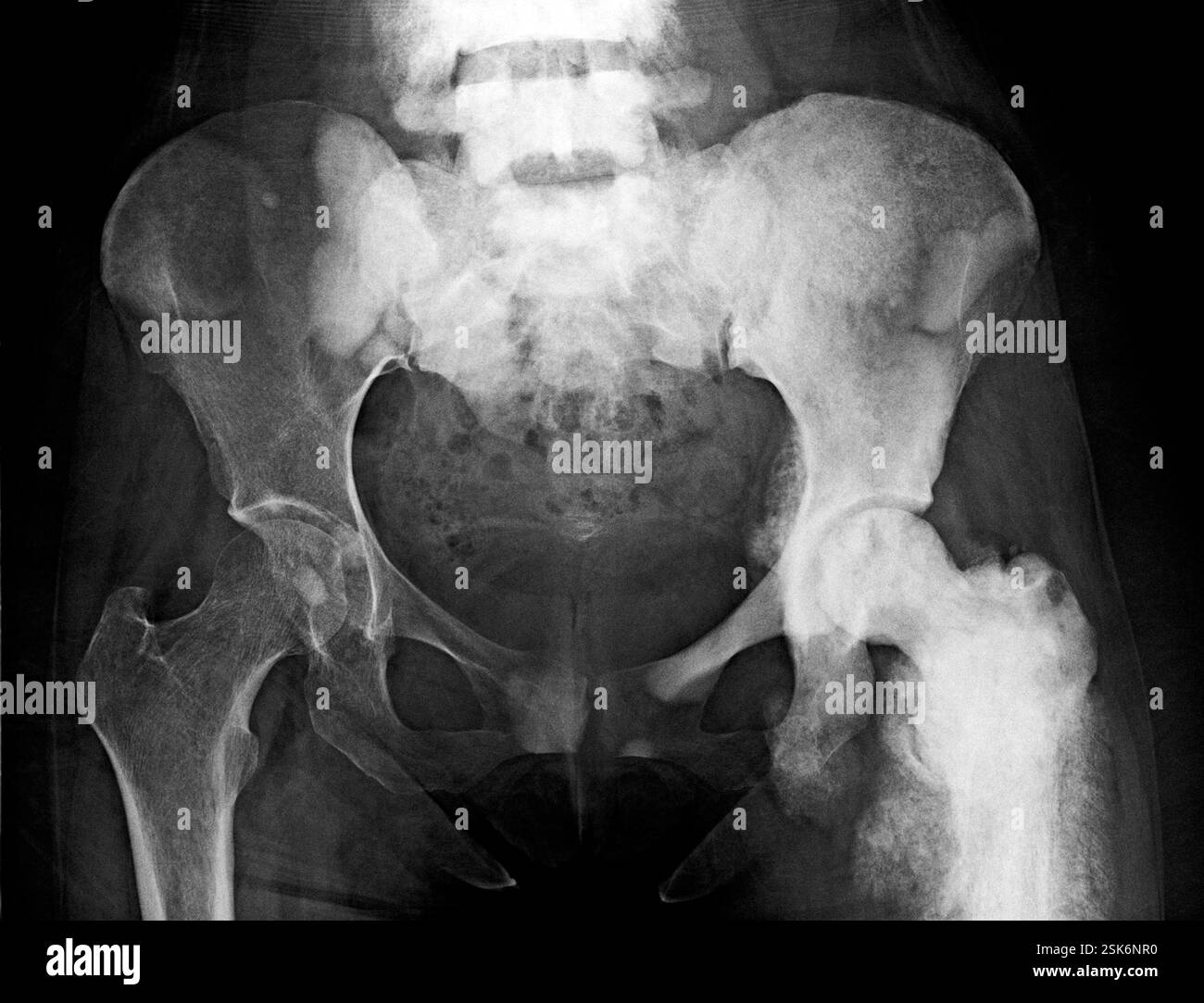 Bone cancer. Frontal X-ray of the pelvis of a patient with an ...