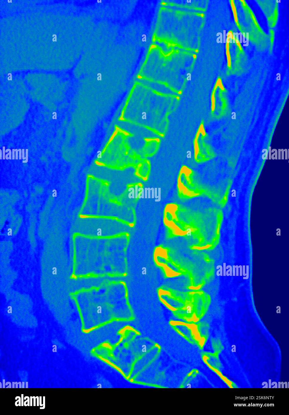 Coloured computed tomography (CT) scan of a side view of the lumbar and ...