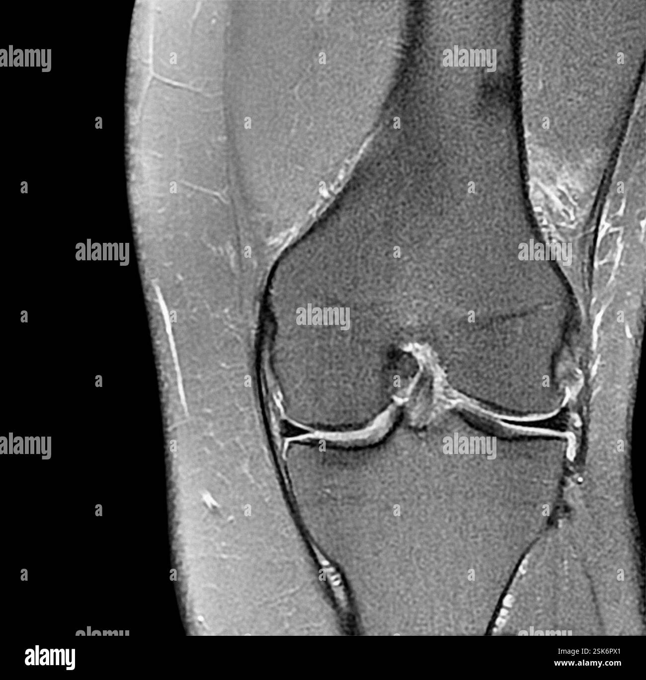 Normal knee. Magnetic resonance imaging (MRI) scan of a section through ...
