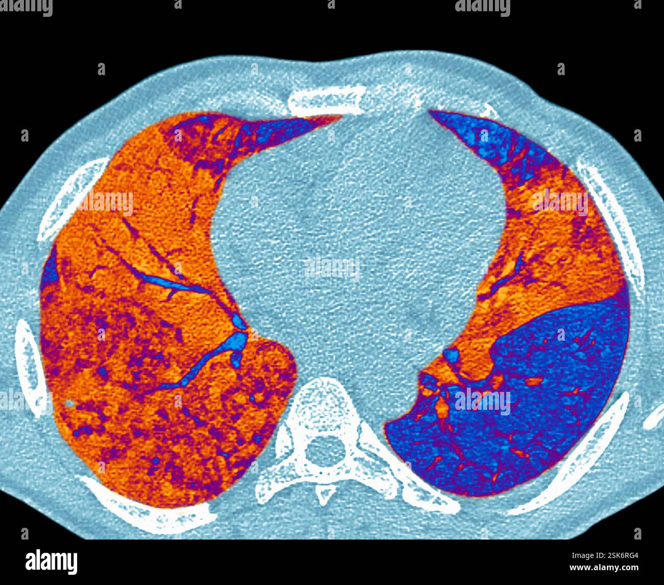 Pneumonia. Coloured computed tomography (CT) scan of an axial section ...
