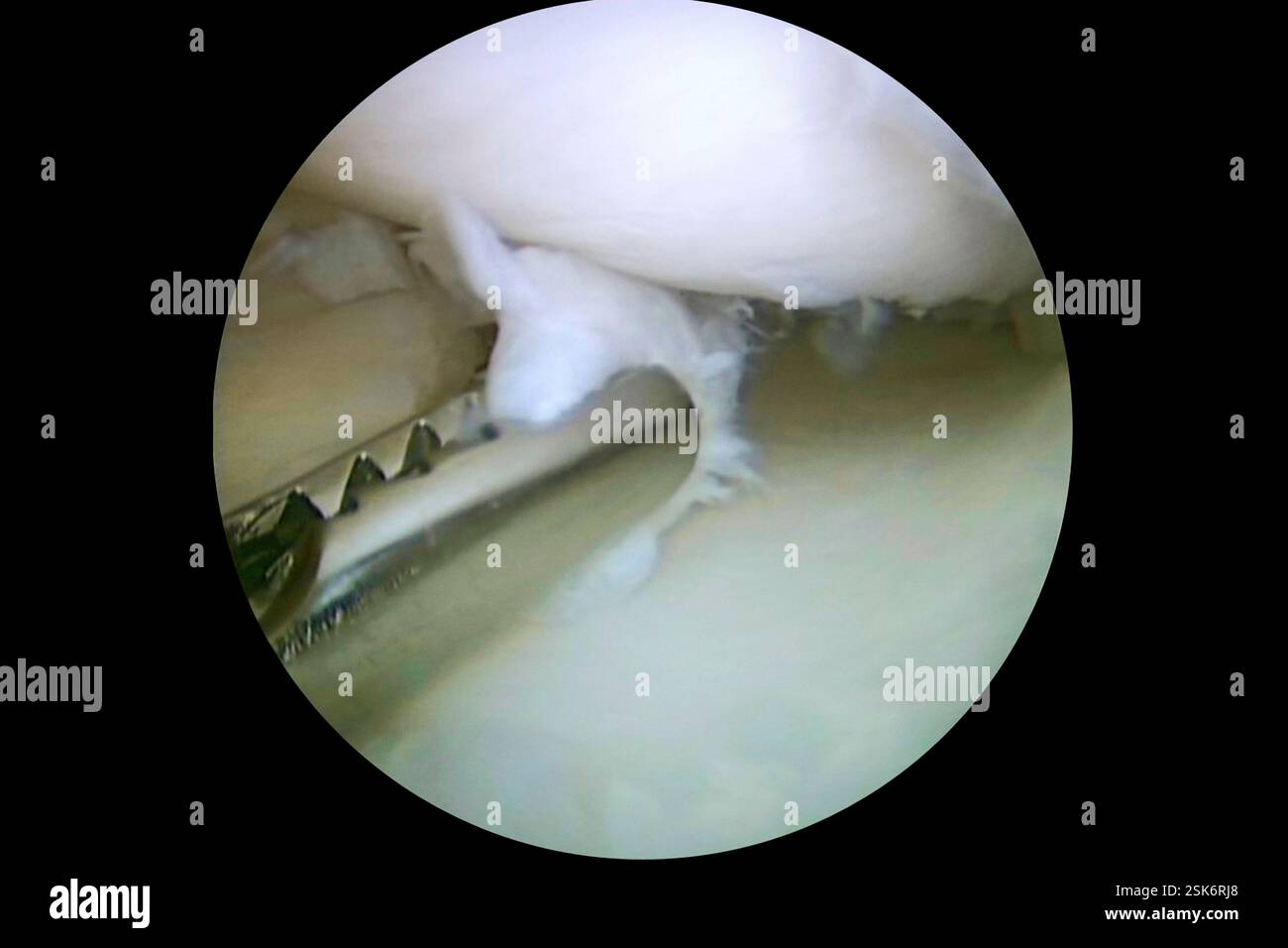 Torn knee cartilage treatment arthroscope endoscope view of the part