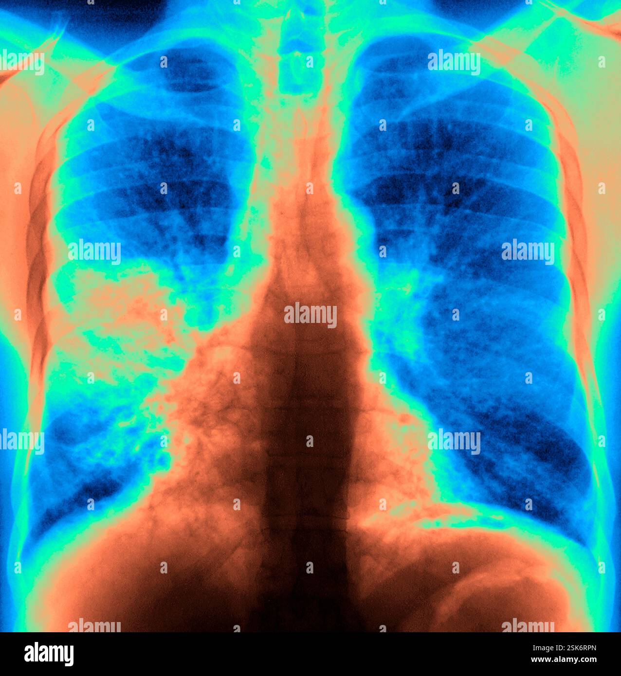 Bacterial Pneumonia Frontal Chest X ray Of The Lungs Of A Patient With bacterial-pneumonia-frontal-chest-x-ray-of-the-lungs-of-a-patient-with