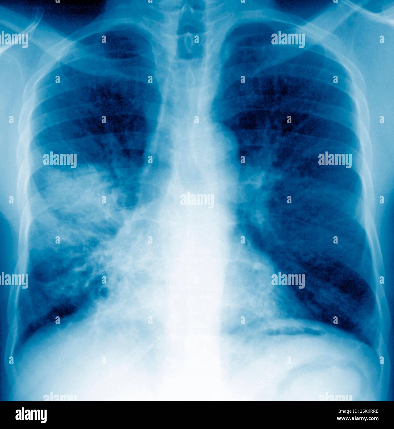 Bacterial Pneumonia Frontal Chest X ray Of The Lungs Of A Patient With bacterial-pneumonia-frontal-chest-x-ray-of-the-lungs-of-a-patient-with