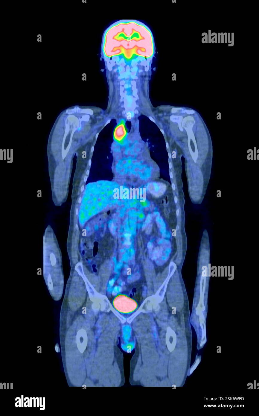 Lymph node cancer. Combined frontal computed tomography (CT) and ...