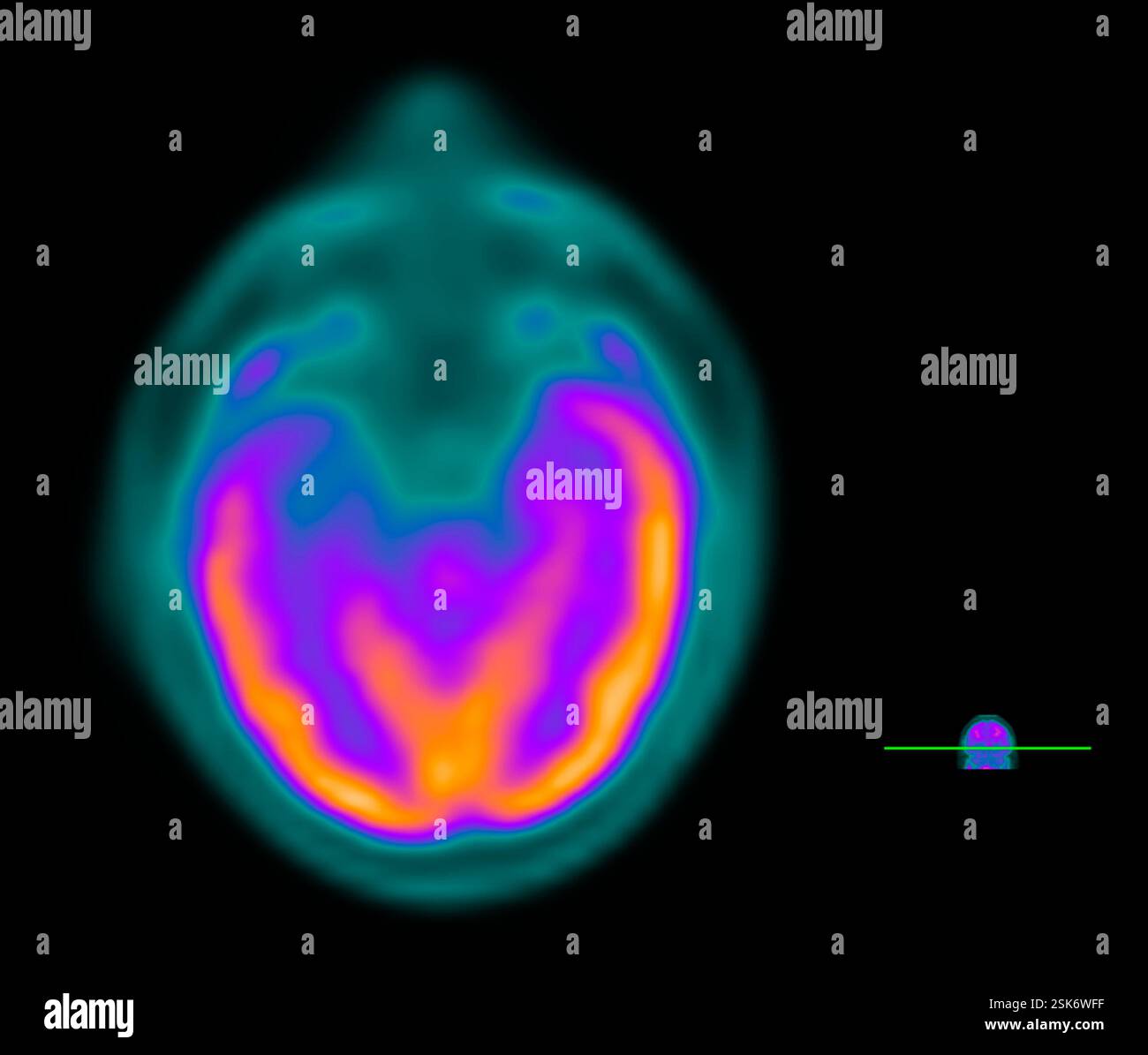 Epileptic brain. Combined cross-sectional computed tomography (CT) and ...