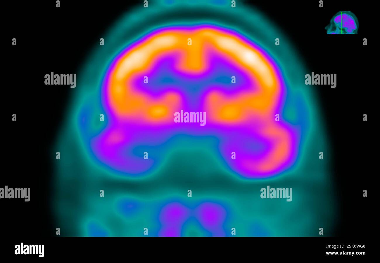 Epileptic brain. Combined frontal computed tomography (CT) and positron ...