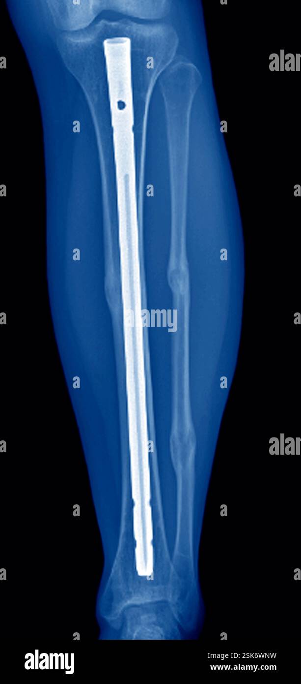 Coloured X-ray (front view) of the fractured (broken) tibia and fibula ...