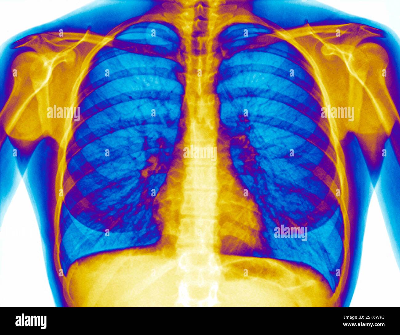 Coloured chest X-ray (front view) of the healthy lungs in a 24 year old ...