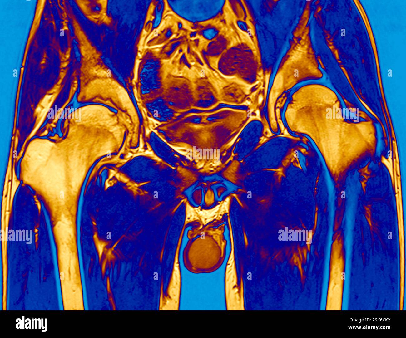Secondary lymph node cancer, CT and PET scan Stock Photo - Alamy