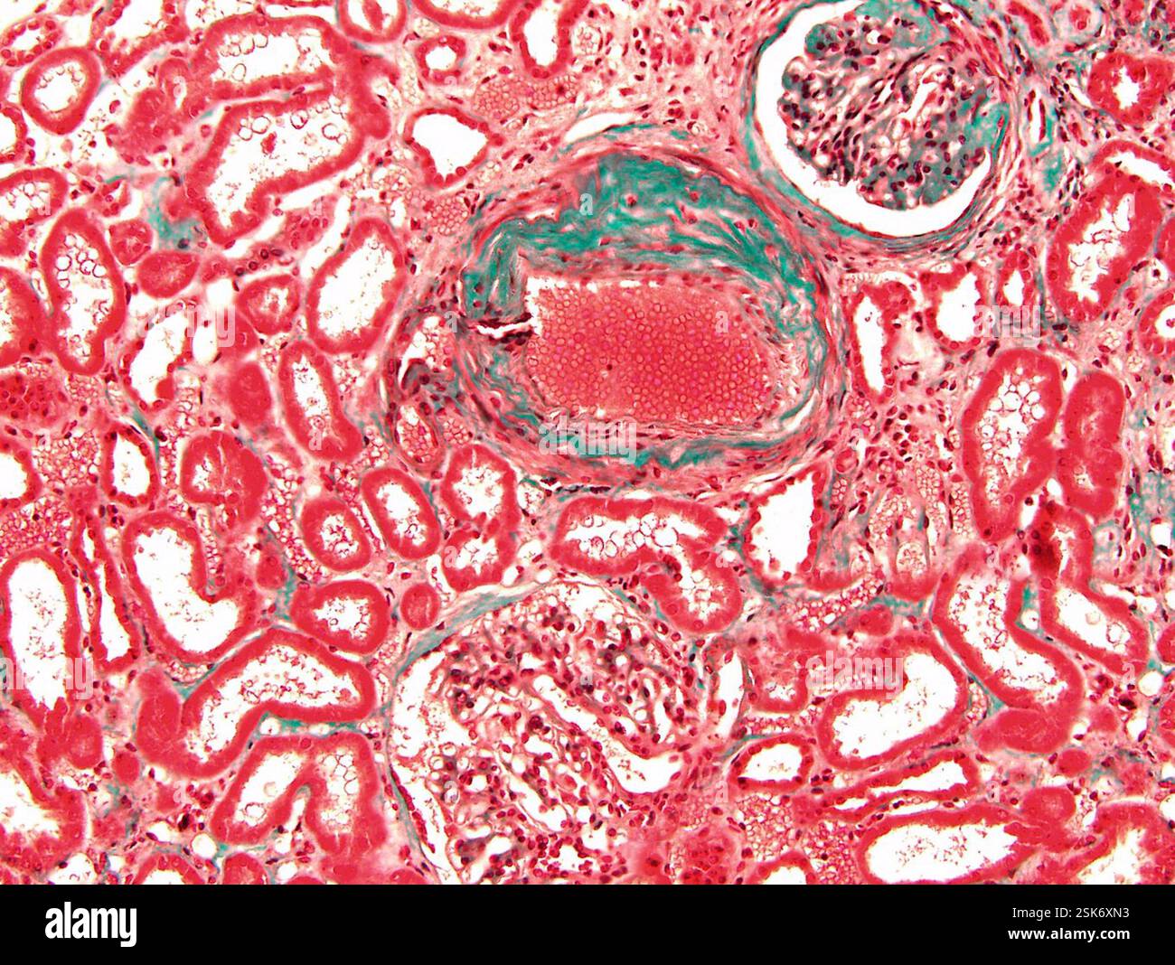nephroangiosclerosis-light-micrograph-of-a-section-through-kidney
