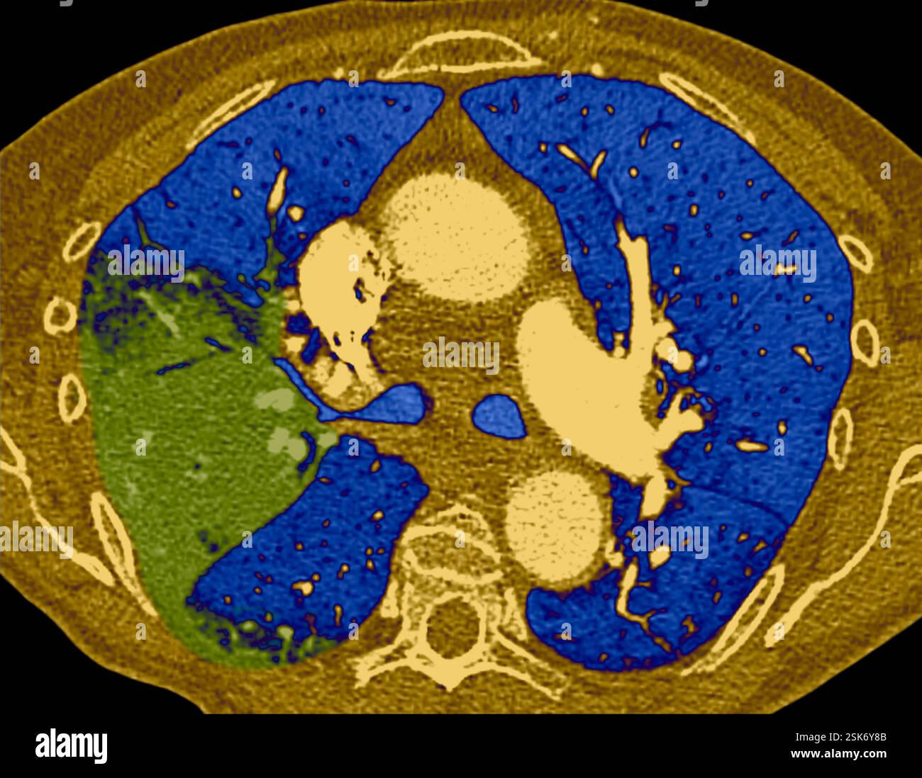 Lobar pneumonia. Coloured axial computed tomography (CT) scan through ...
