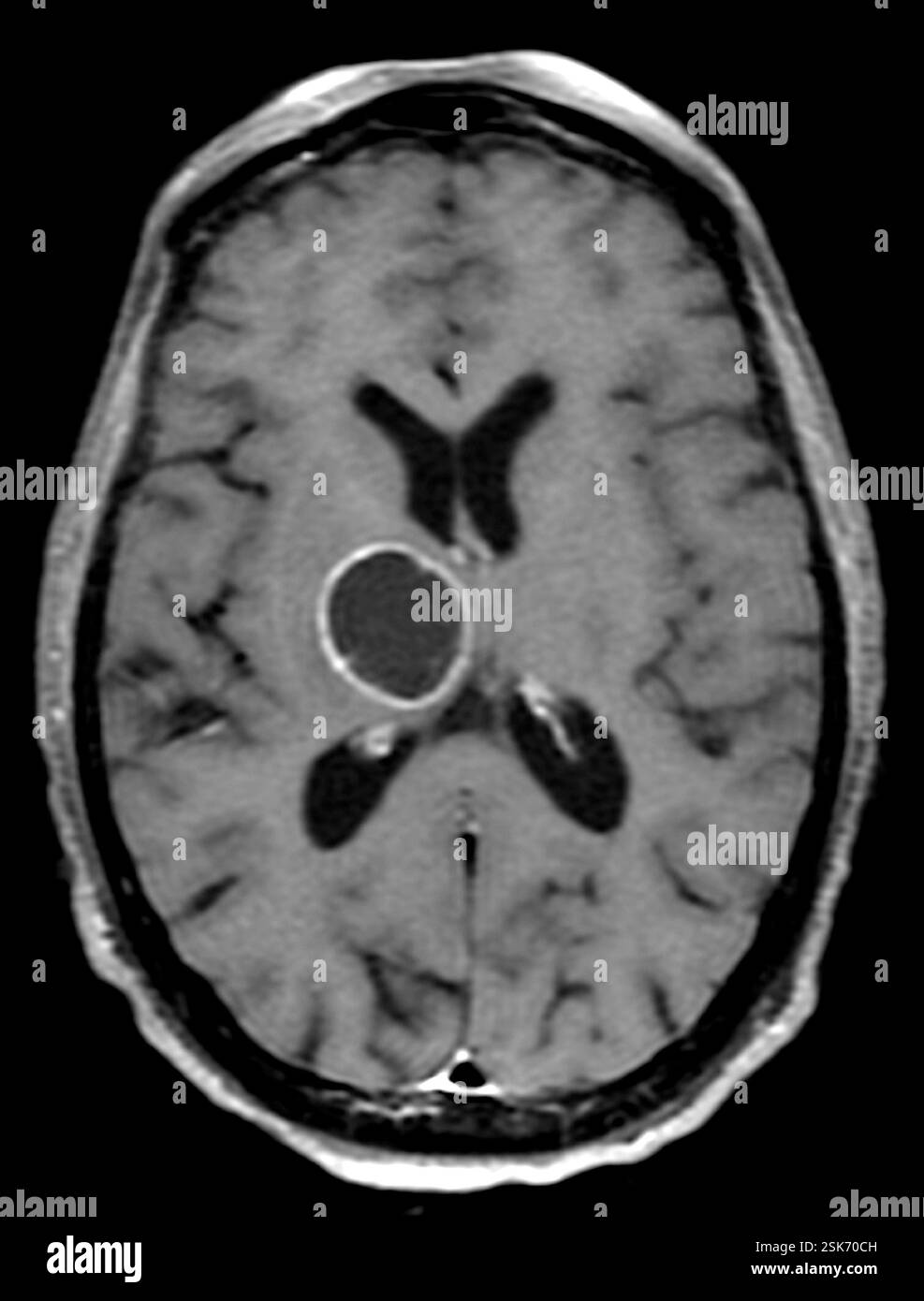 secondary-brain-cancer-axial-magnetic-resonance-imaging-mri-scan