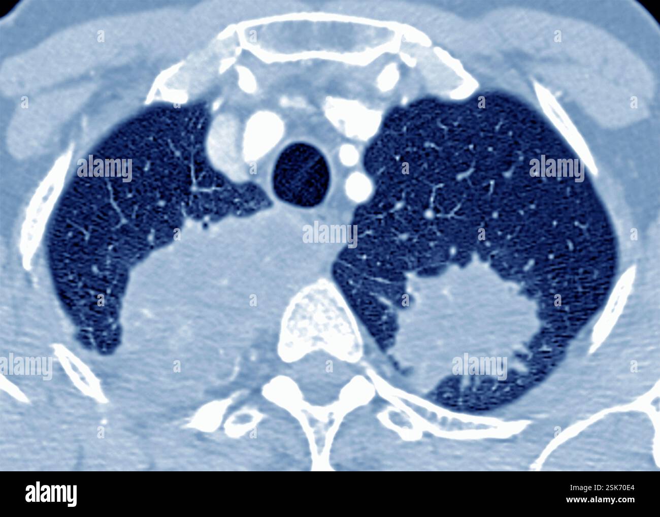 Wegener's granulomatosis. Axial chest computed tomography (CT) scan of ...