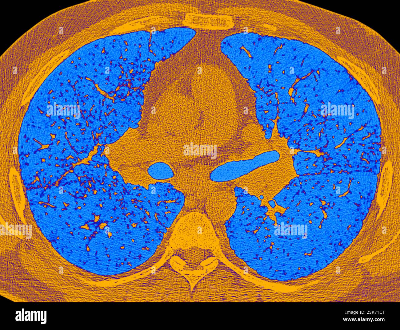Gaucher's disease, light micrograph Stock Photo