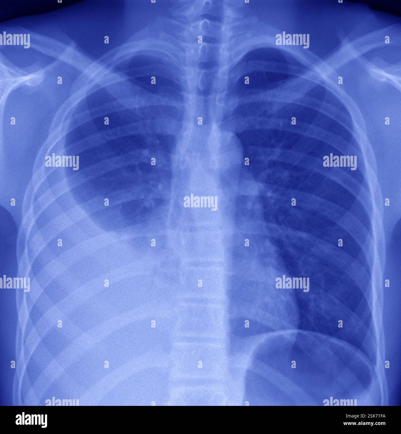 Coloured X-ray of the lungs of a 24 year old male patient with pleurisy ...