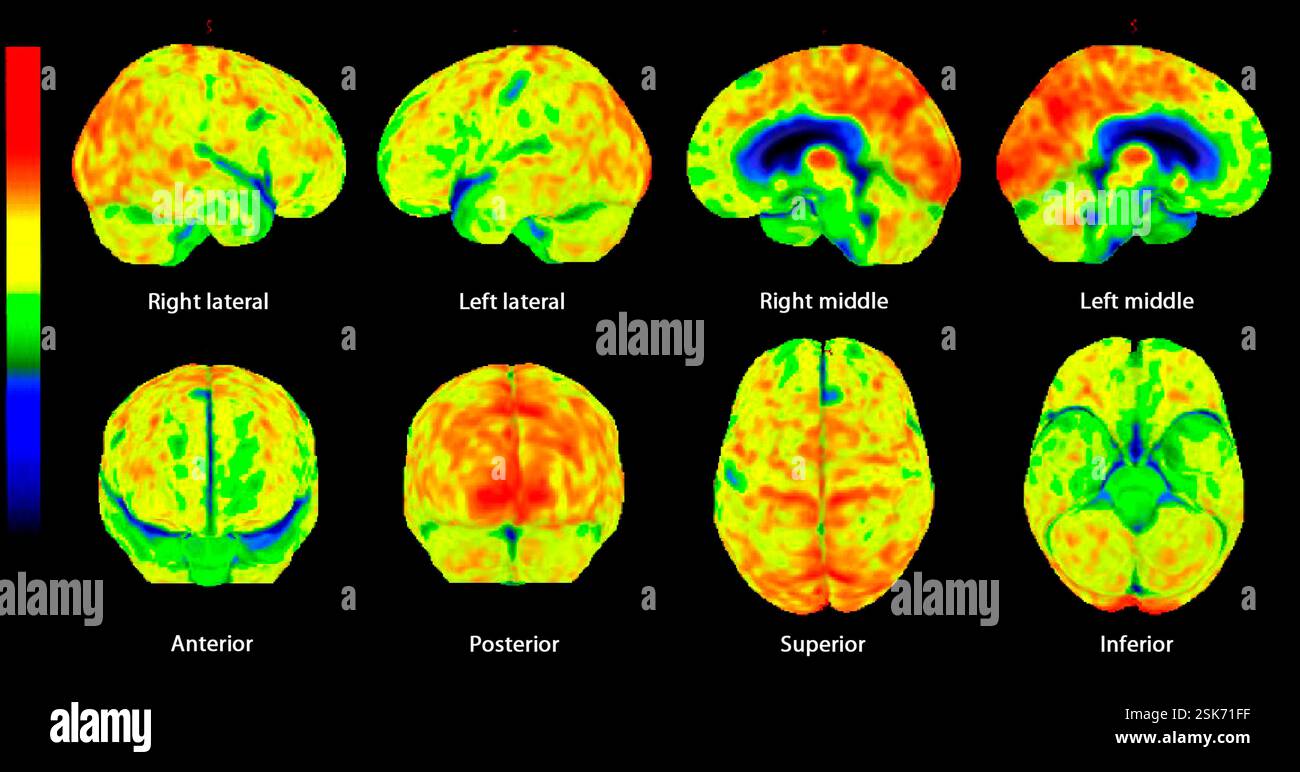 Secondary lymph node cancer, combined CT and PET scans Stock Photo - Alamy