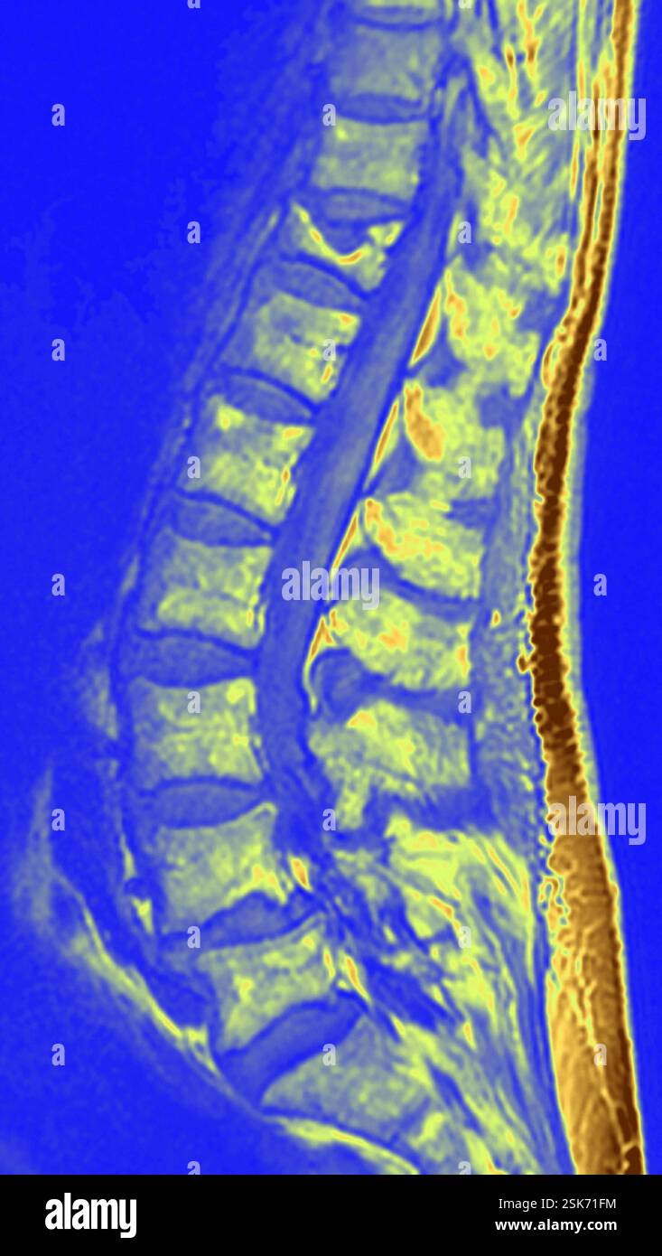 Coloured magnetic resonance imaging (MRI) scan of the spine of a 75 ...