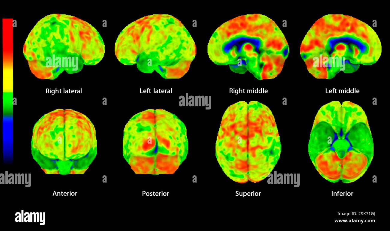 Secondary lymph node cancer, CT and PET scans Stock Photo - Alamy