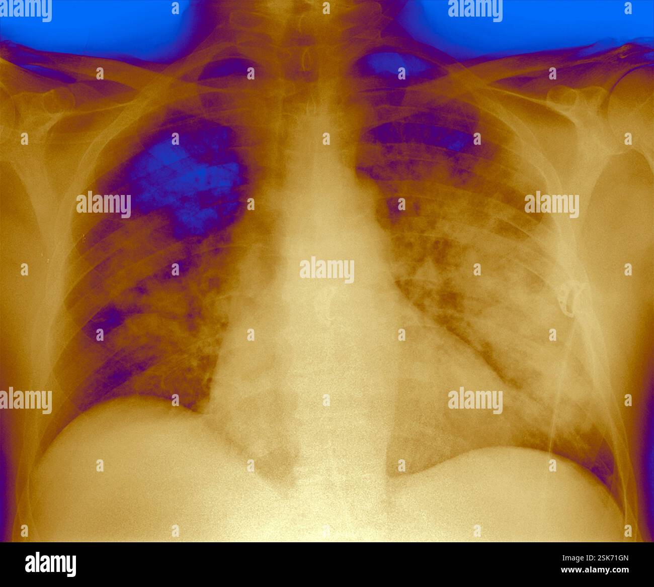 Coloured X-ray of the chest of a 68 year old man with left ventricular ...