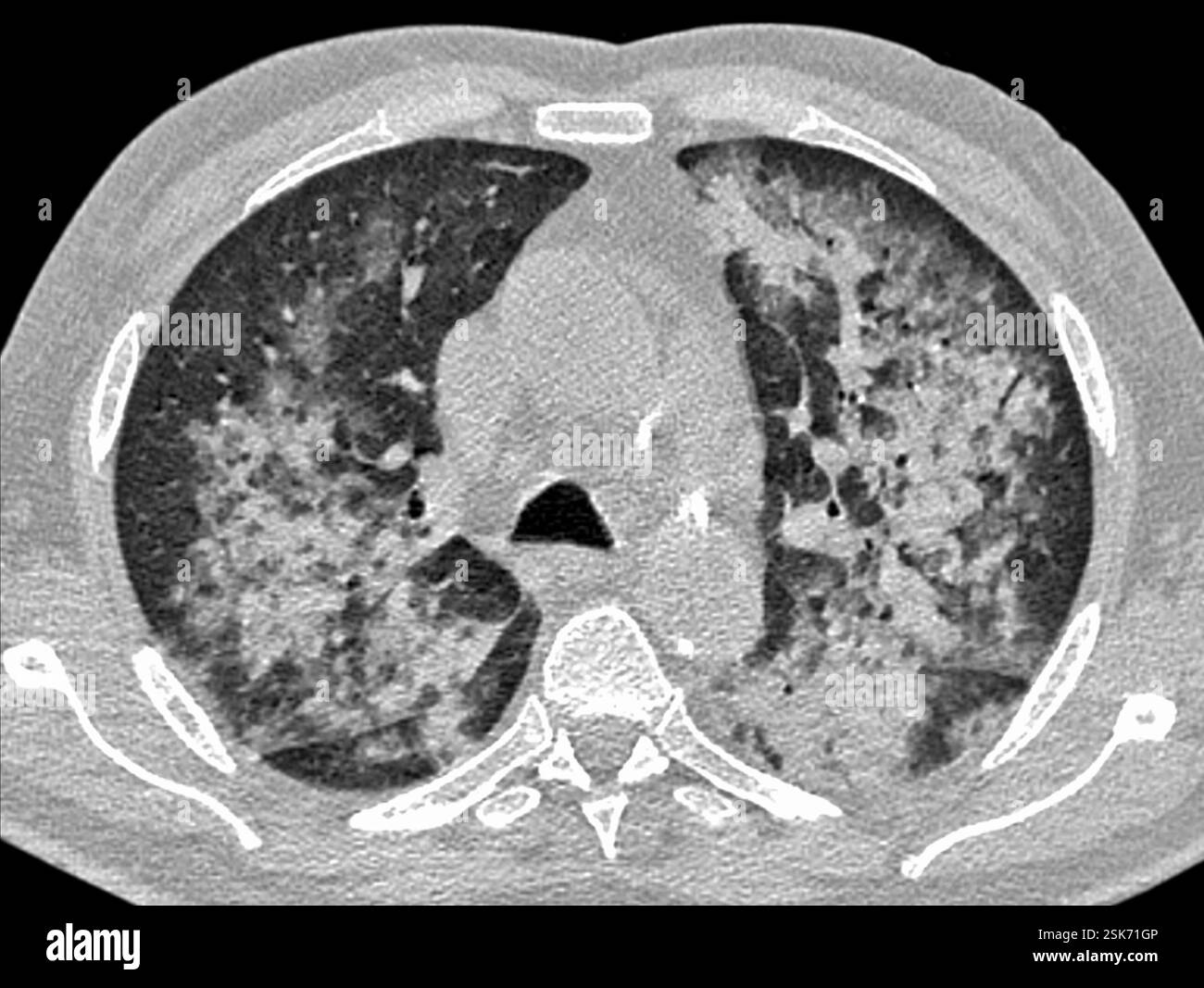 computed-tomography-ct-scan-of-the-chest-of-a-68-year-old-man-with