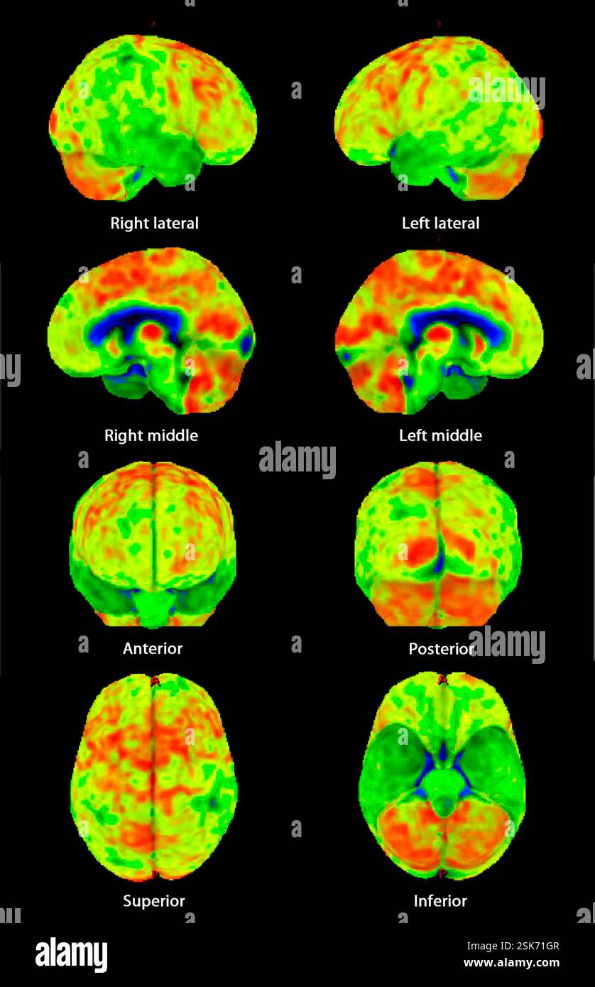 Secondary lymph node cancer, CT and PET scans Stock Photo - Alamy