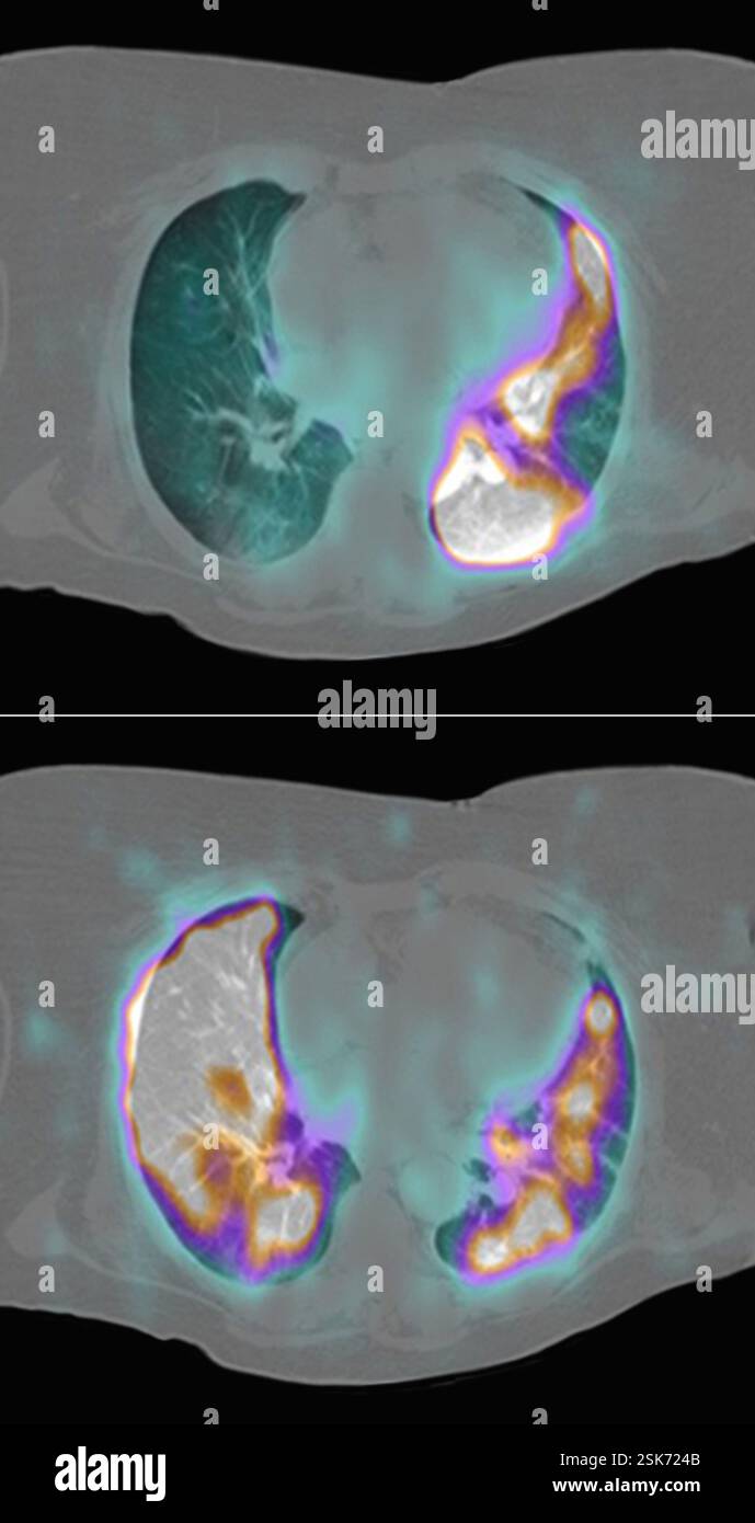 Diffuse large B-cell lymphoma, CT and PET scans Stock Photo - Alamy