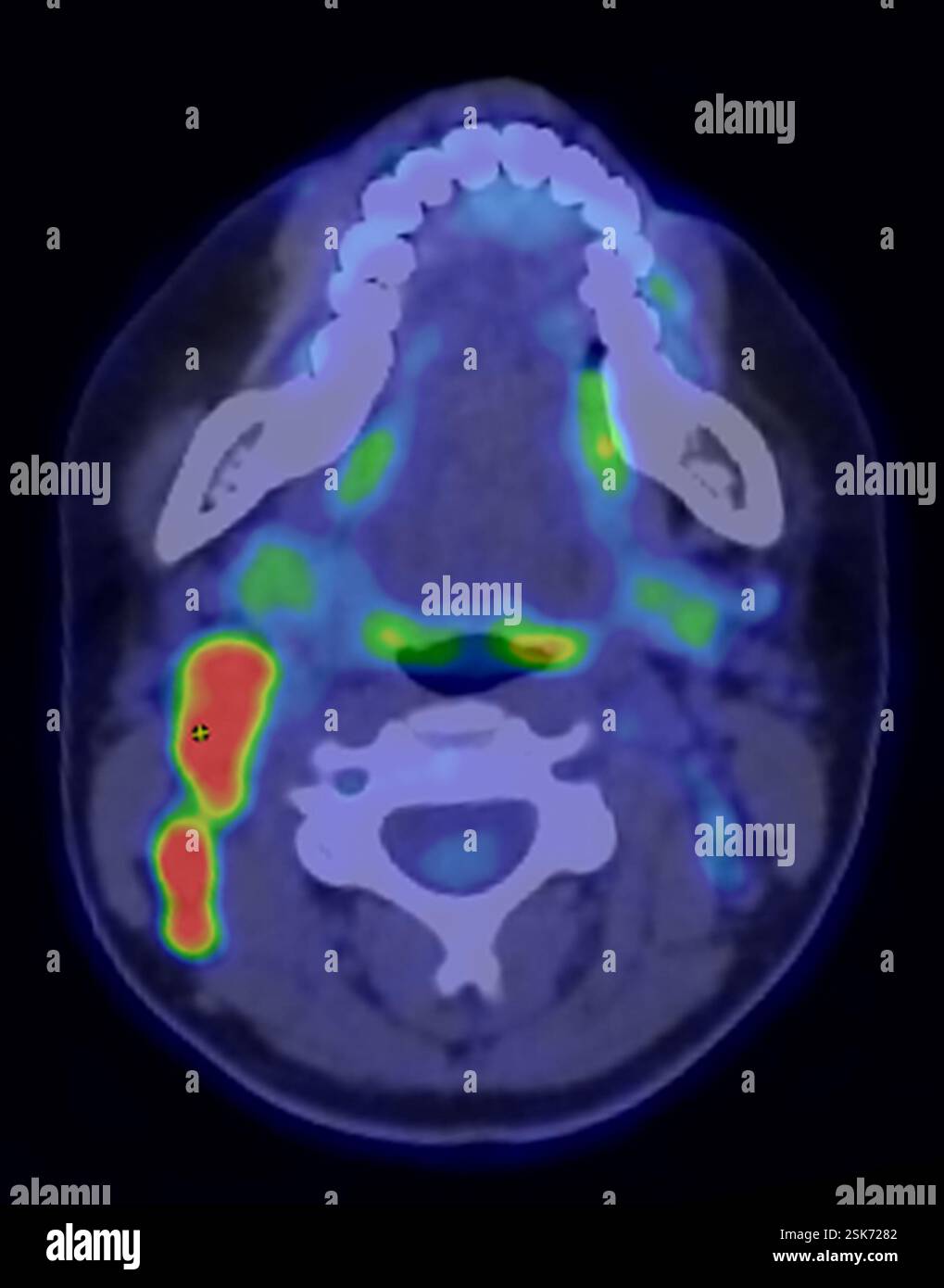 Coloured computed tomography (CT) and positron emission tomography (PET ...
