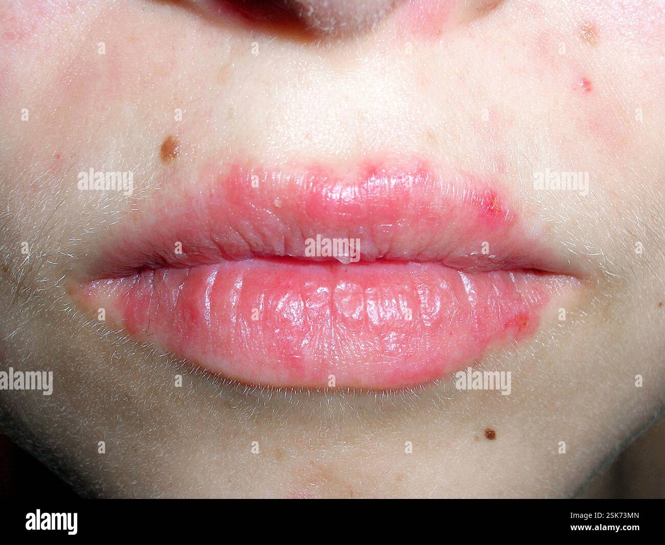 Acute cutaneous lupus rash on the lips of a 22 year old female patient ...