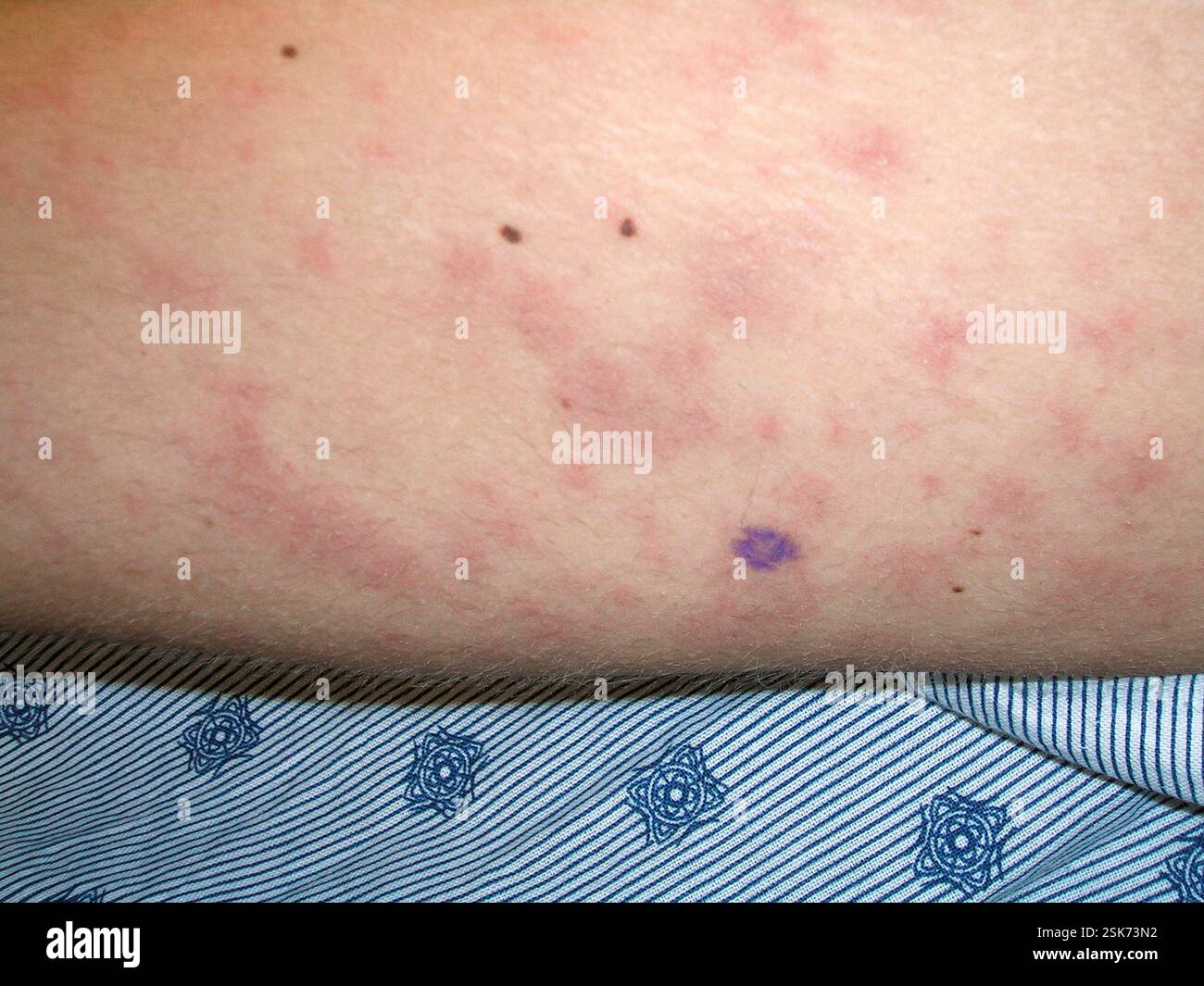 Acute cutaneous lupus rash on the skinof a 22 year old patient with