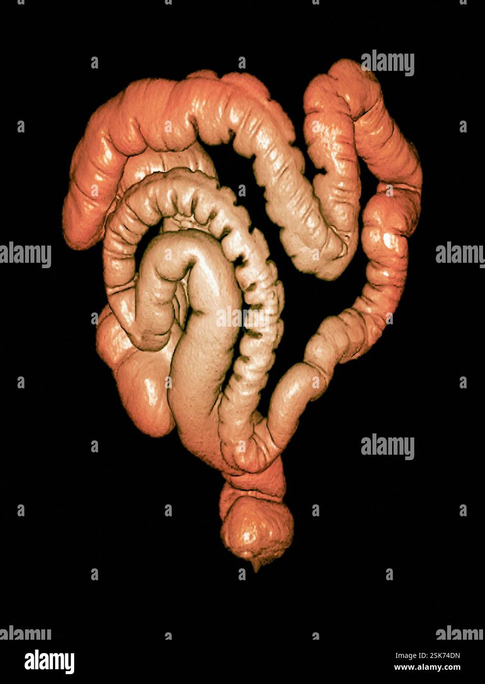Normal colon. Coloured frontal 3D computed tomography (CT) scan of a ...