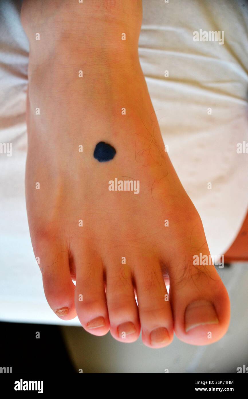 nevus-blue-nevus-on-the-right-foot-of-a-25-year-old-female-patient-a