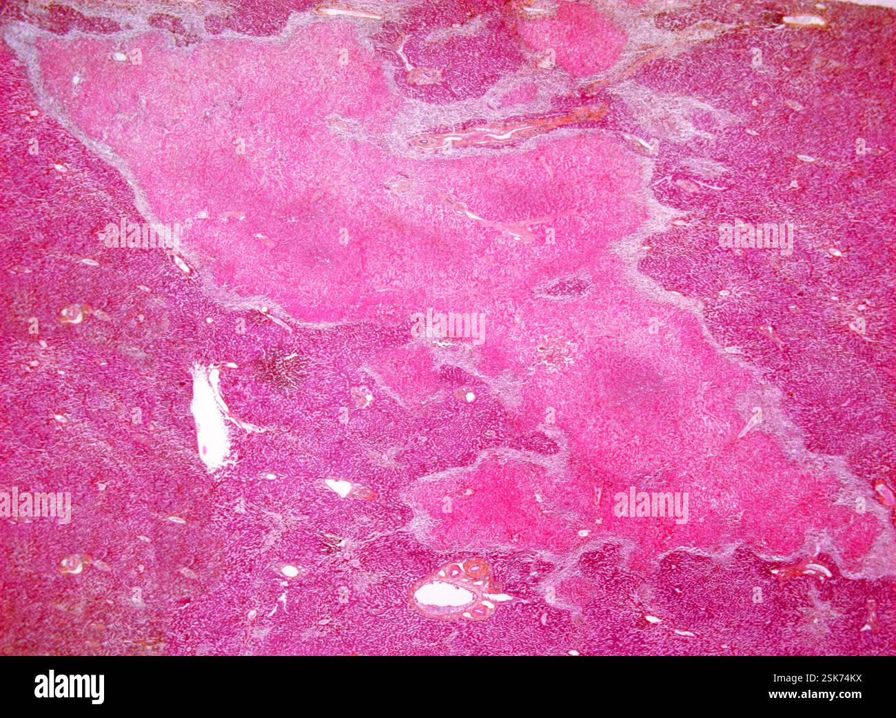 Tissue Death Liver infarction. Light micrograph of a section through human liver ...