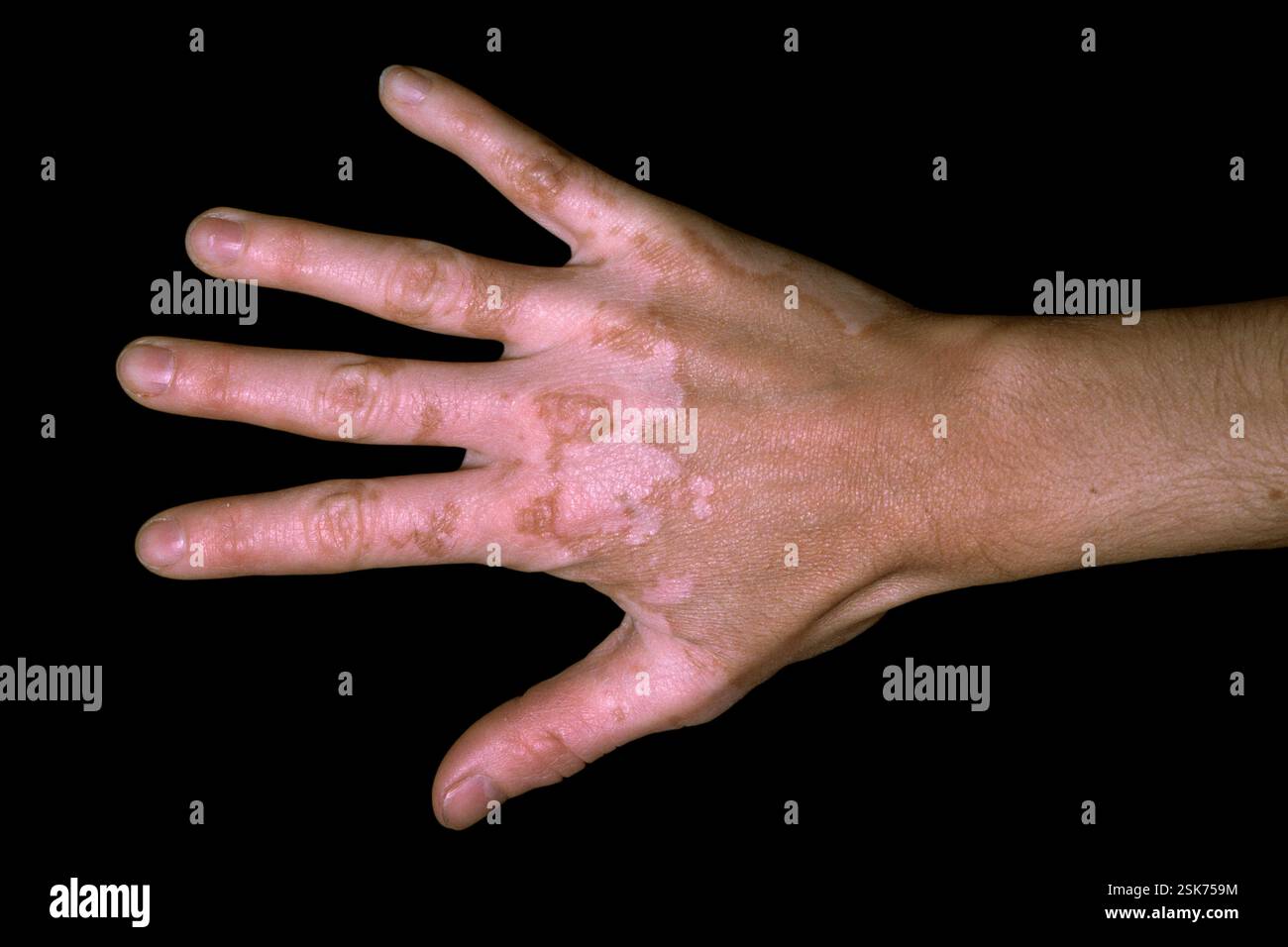 Vitiligo. Lesions on the hand of a 40-year-old female patient with